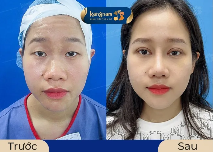 Mí mắt ban đầu được nâng lên, không còn che lấp đồng tử 