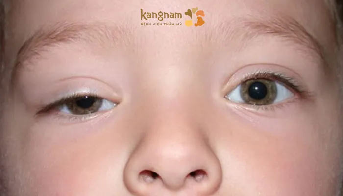 Tình trạng sụp mí bẩm sinh