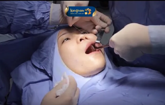 Bác sĩ đang tiến hành tạo hình má lúm cho khách hàng