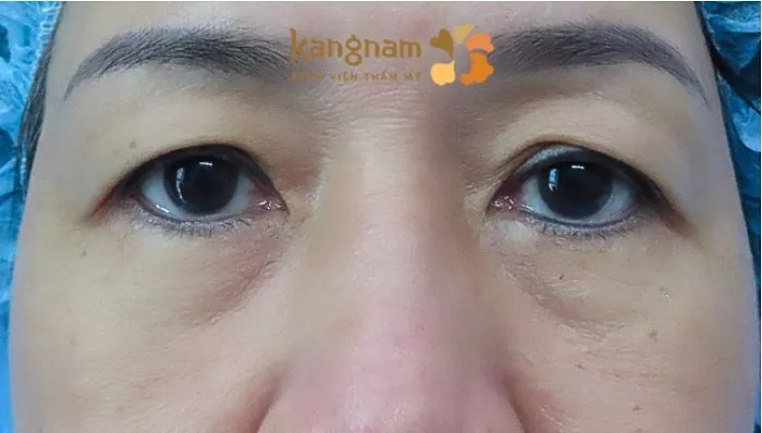 Tình trạng sụp mí ở người lớn