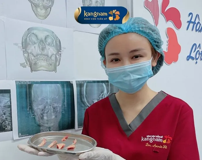 Hình ảnh xương góc hàm sau gọt