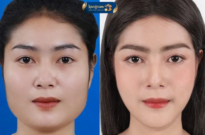 Mặt vuông, cằm bạnh được khắc phục hoàn toàn sau 1 lần phẫu thuật