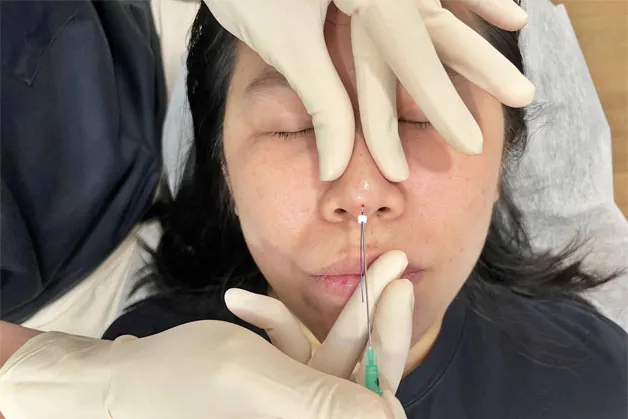Nâng mũi bằng chỉ an toàn khi được thực hiện đúng kỹ thuật và đảm bảo vô trùng, bác sĩ đang cấy chỉ vào mũi