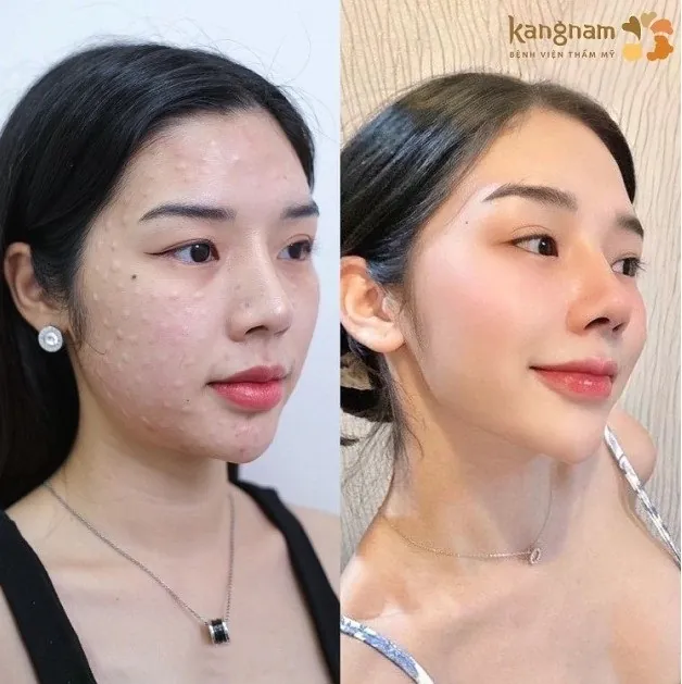 Tiêm meso để cải thiện nếp nhăn, làm da căng bóng, tươi trẻ