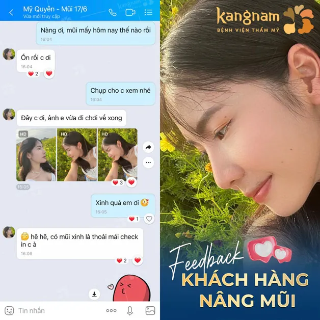 Khách hàng hài lòng khi nâng mũi tại Kangnam