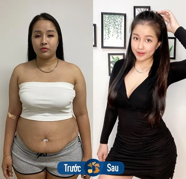 Tự tin với đường cong hoàn hảo sau hút mỡ