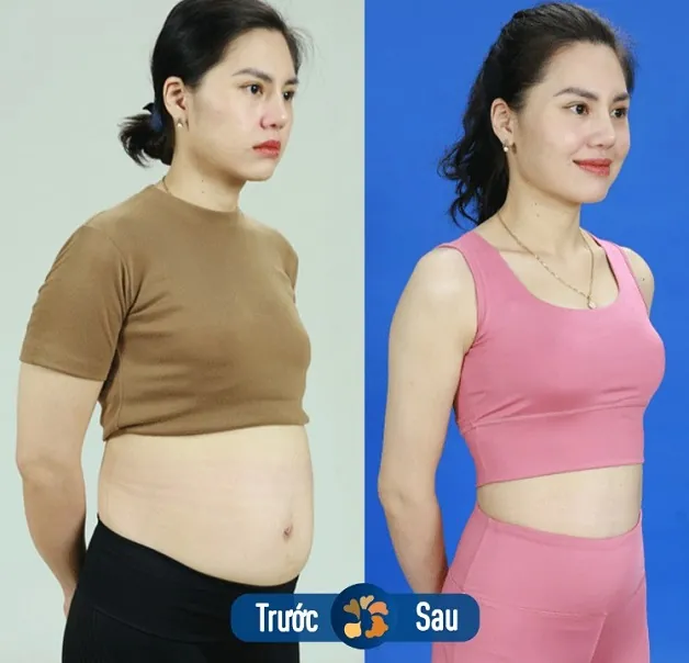 Bụng mỡ sau sinh được khắc phục hiệu quả