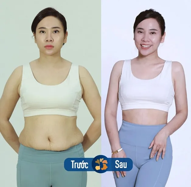 Vòng 2 thon gọn ngay sau khi hút và tạo hình thành