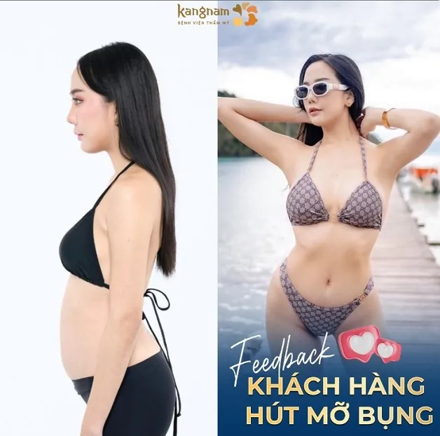 Bụng nhỏ eo thon nhanh chóng sau khi hút mỡ