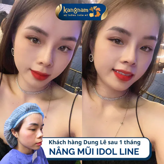 Nâng mũi chuẩn Idol Hàn Quốc