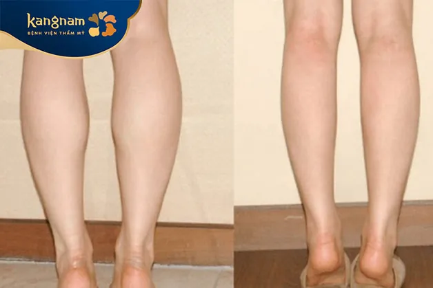 Đôi chân thon gọn rõ rệt sau giảm mỡ