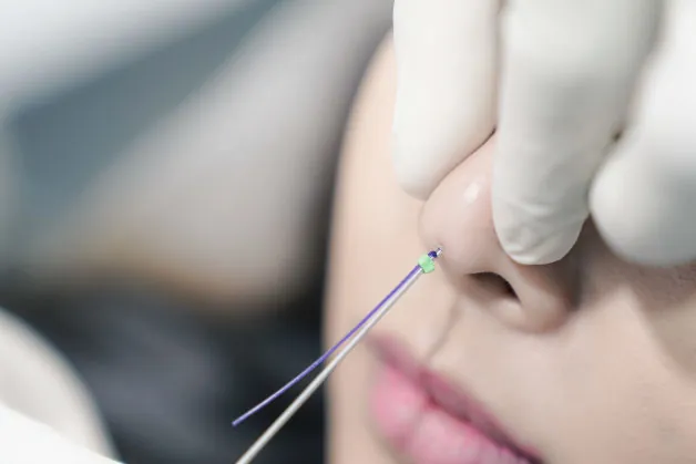 quá trình nâng mũi bằng chỉ sử dụng các sợi chỉ chuyên dụng (thường có gai móc hoặc xoắn) đưa vào dưới da mũi thông qua một đầu kim siêu nhỏ