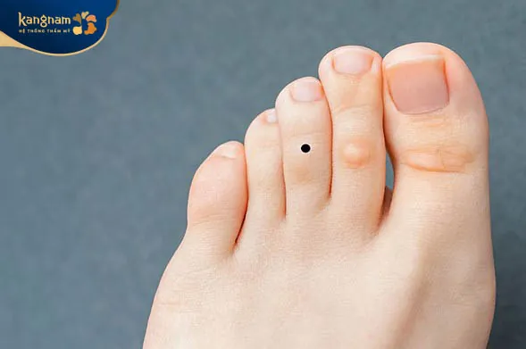 Nốt ruồi ngón chân giữa là điềm báo về đường công danh sự nghiệp không được tốt