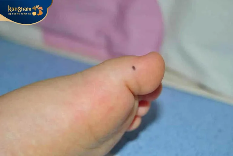 Nốt ruồi ở ngón chân mang nhiều ý nghĩa