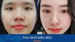 Cách thu nhỏ đầu mũi hiệu quả: Hướng dẫn và lời khuyên từ chuyên gia