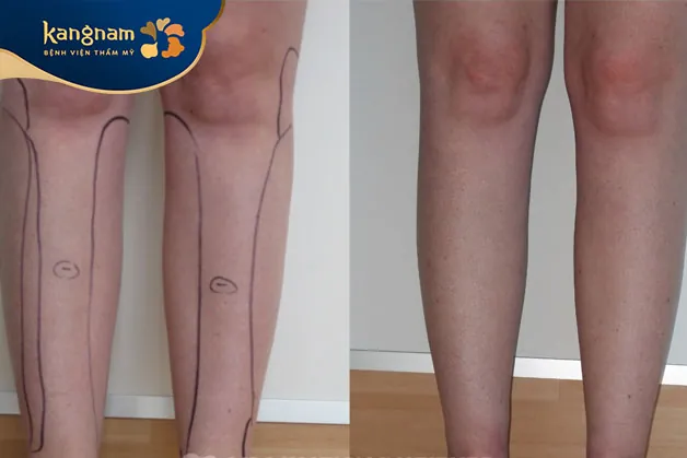 Giảm mỡ bắp chân nhanh chóng tại Kangnam
