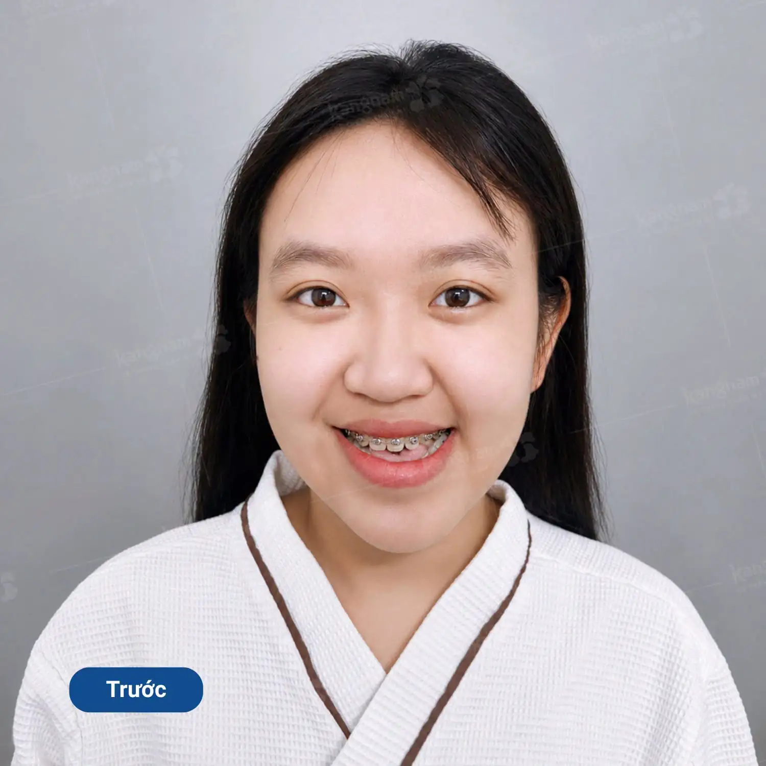 Mặt bị lệch là khi các đường nét trên mặt như mắt, mũi, miệng, nhân trung và hai bên góc hàm không đối xứng