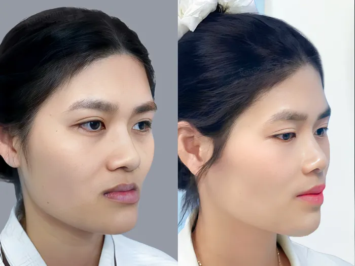 Khuôn mặt cân đối hơn sau khi chỉnh hàm