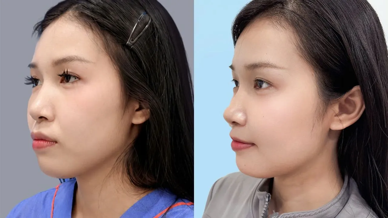 Ngọc Trâm và khuôn mặt mới sau chỉnh hàm hô