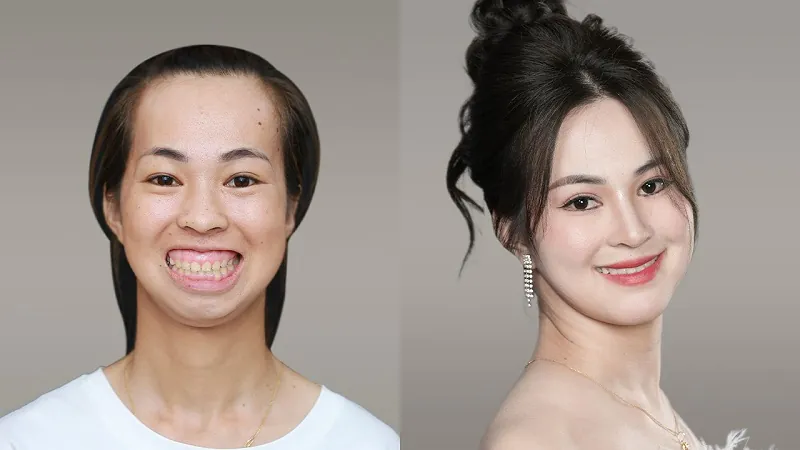 Kim Phượng lột xác ngoạn mục sau chỉnh hàm tại Kangnam
