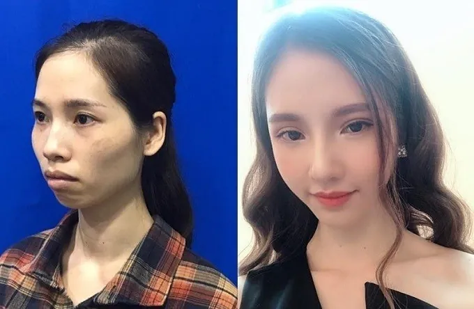Phan Thị May ngọc nữ có màn lột xác ngoạn mục sau phẫu thuật thẩm mỹ