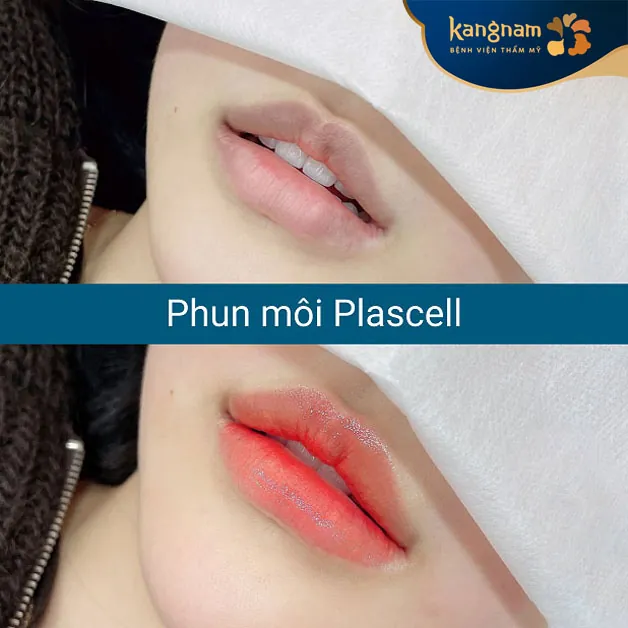 Công nghệ phun môi collagen hiện đại