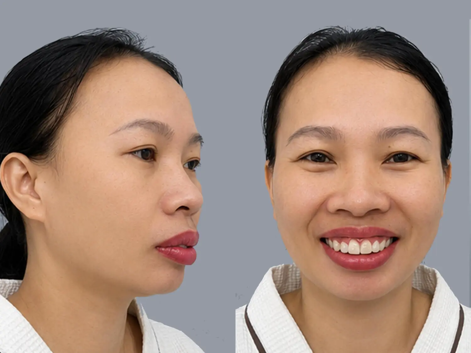 Chị Thanh gặp tình trạng hàm hô chìa ra trước, cằm ngắn