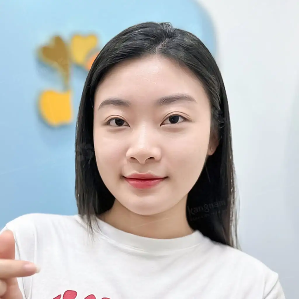Sau trượt cằm và gọt hàm gương mặt Yến Nhi đã thon gọn hơn