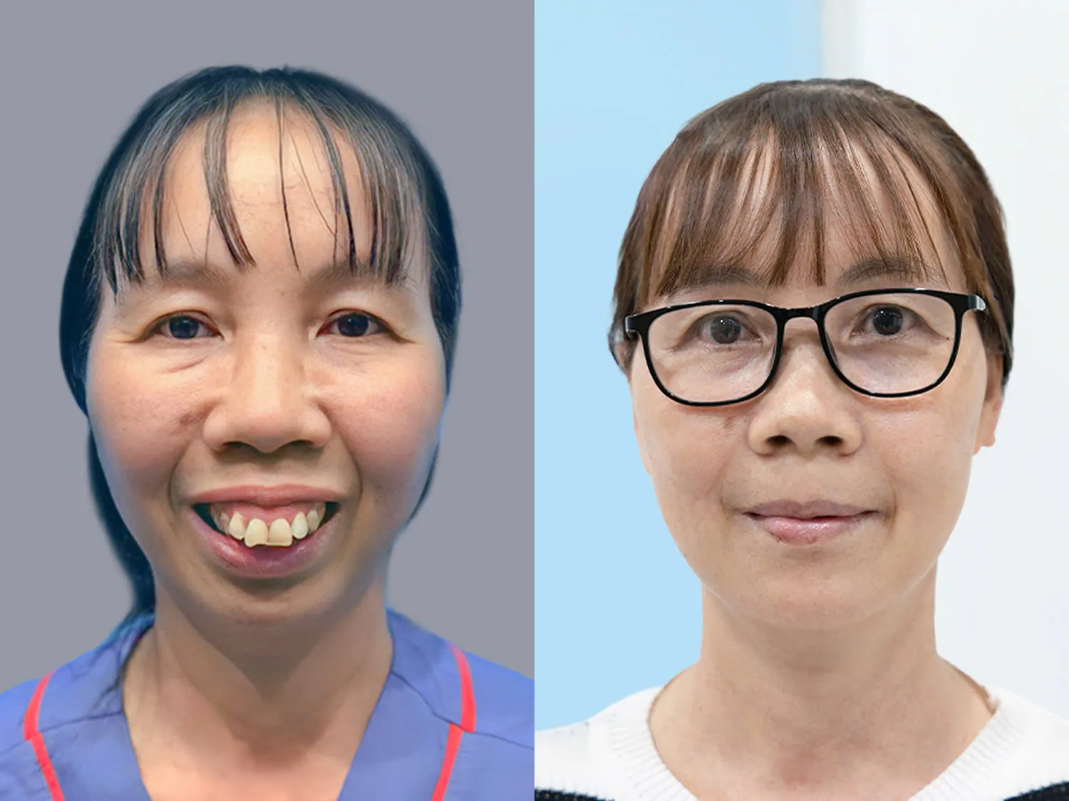 Cô Vũ Thị Thảo minh chứng chỉnh hàm ở độ tuổi 50