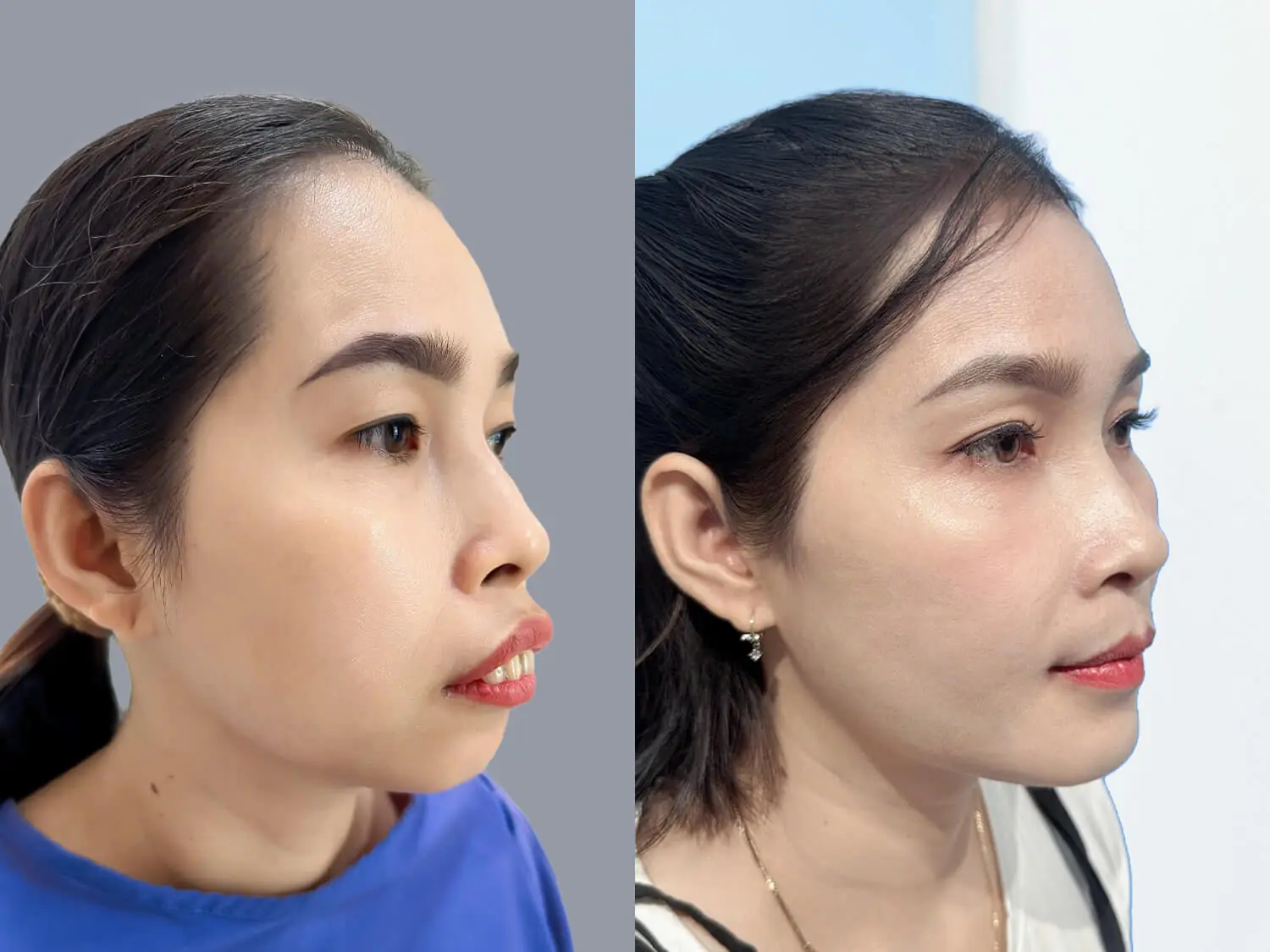 Chị Loan trước và sau chỉnh hàm kết hợp trượt cằm