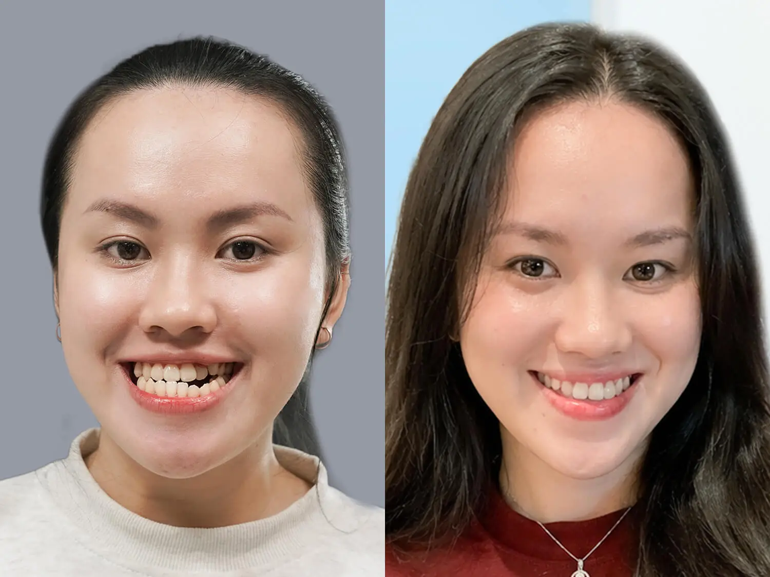 Diện mạo mới của Phương Quyên khi chỉnh hàm móm đã ổn định