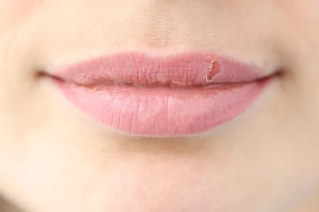 Môi sau khi phun có hiện tượng bong nhưng không lên màu