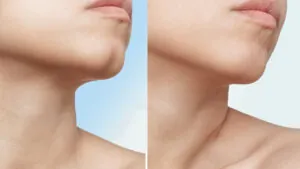 Cằm chẻ là gì? Giải mã tướng số và phương pháp tạo cằm chẻ hiện đại