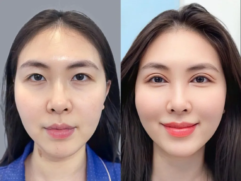 Cắt mí tại cơ sở thẩm mỹ uy tín giúp mắt cân đối, to tròn và an toàn