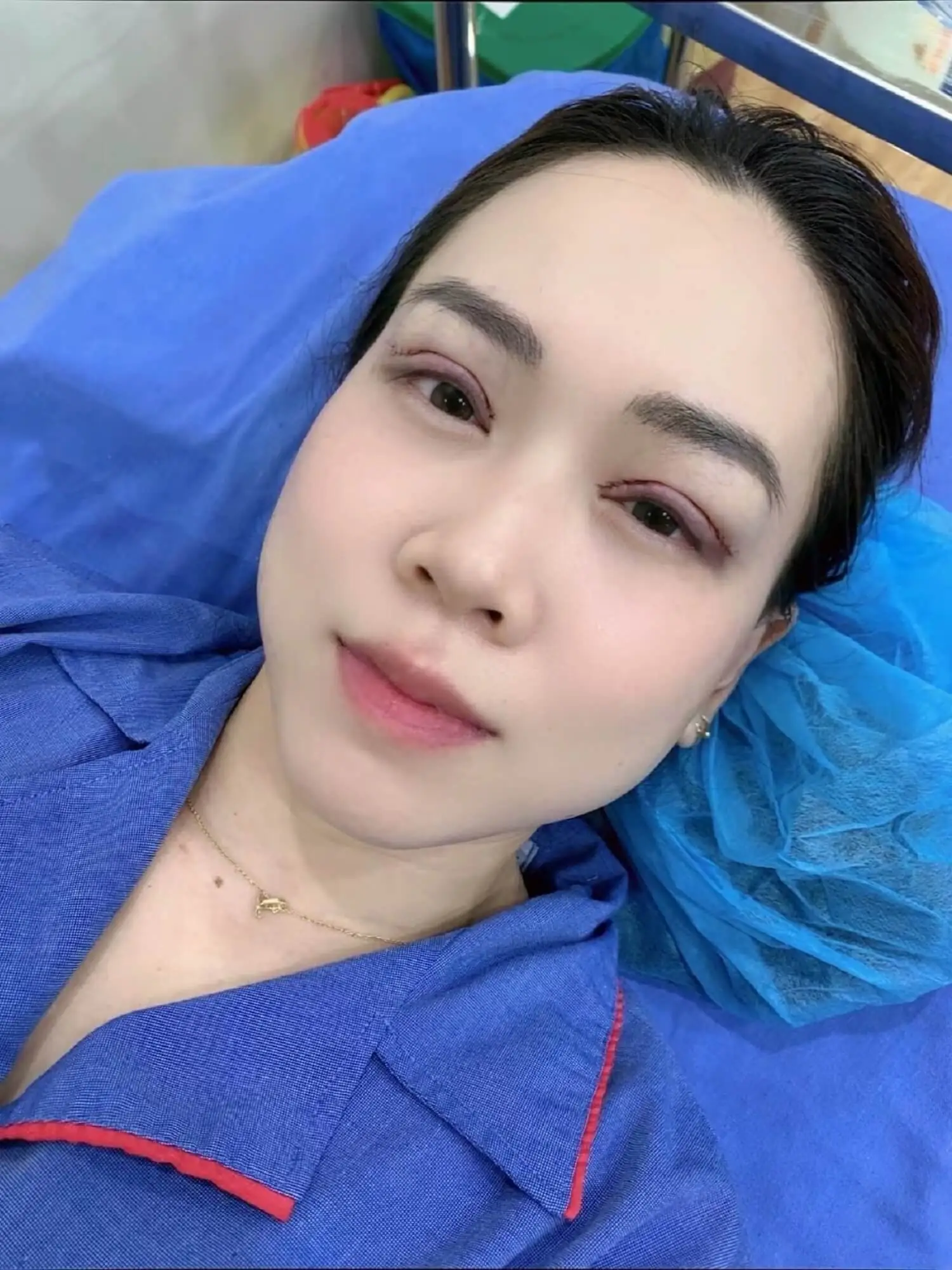 Sau khi cắt mí, vùng mắt sẽ hơi sưng tấy, bầm tím