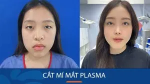 Giải mã phương pháp cắt mí mắt Plasma: "Cứu tinh" cho đôi mắt mí lót, sụp mí