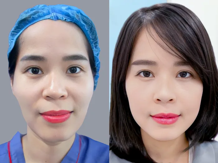 Phương pháp cấy mỡ mặt đang trở thành lựa chọn phổ biến, được nhiều chị em săn lùng