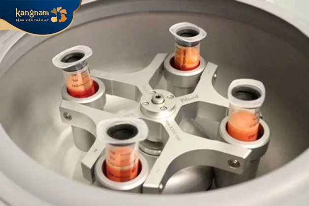 Chiết tách ly tâm mỡ trước khi cấy vào ngực