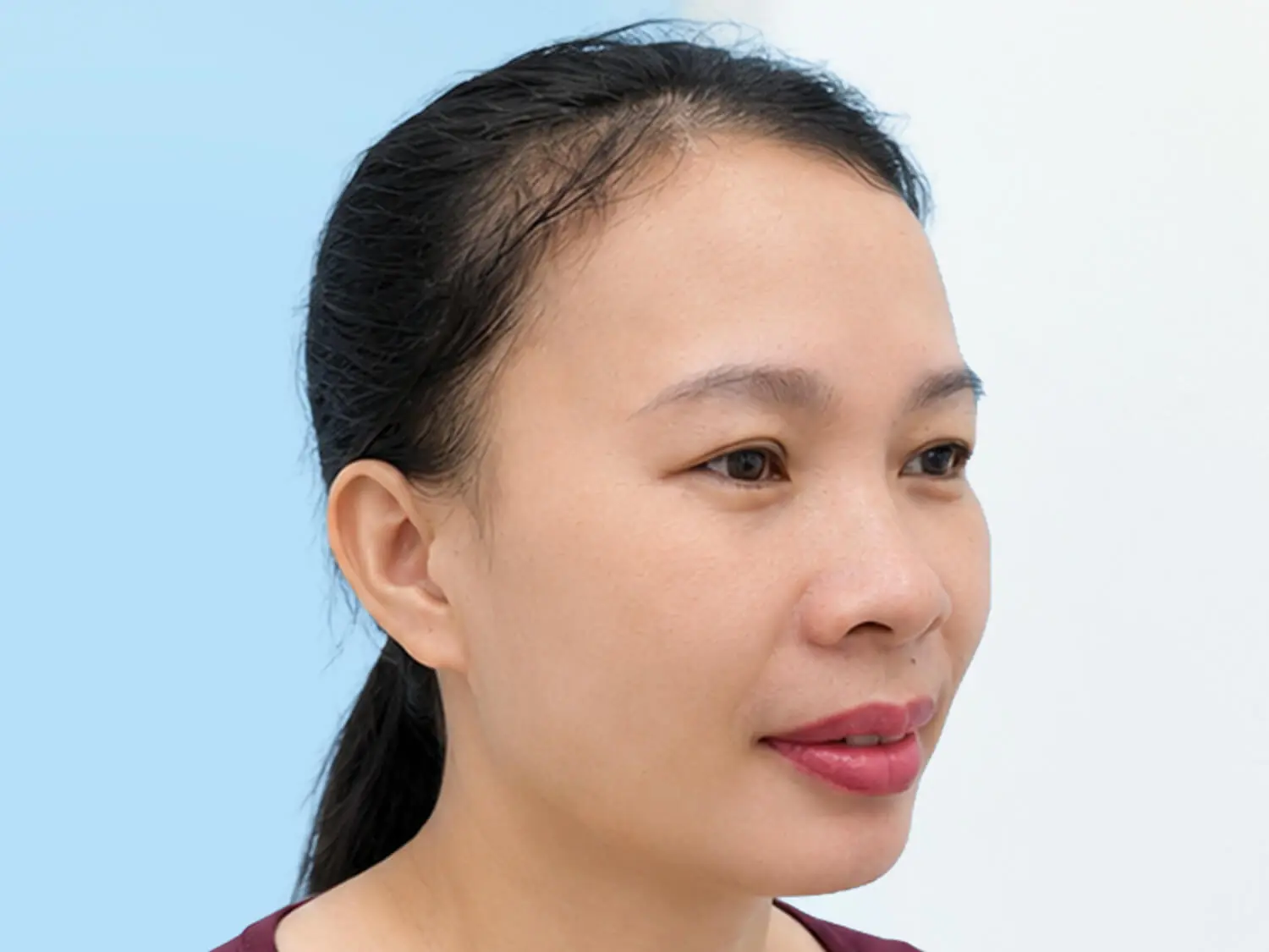 Sau chỉnh hàm và trượt cằm gương mặt chị Thanh đã có sự thay đổi rõ rệt