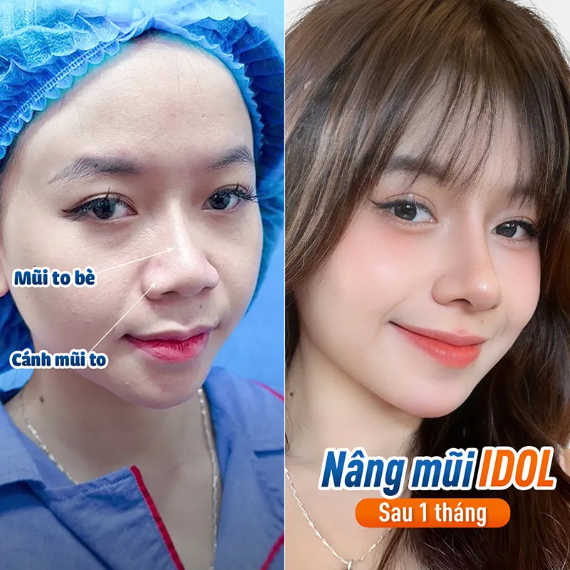 Hình ảnh dáng mũi sau 1 tháng, form mũi ổn định, hài hòa với gương mặt