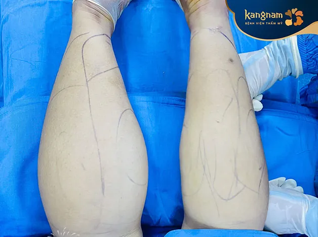 Giảm mỡ bắp chân nhanh chóng không để lại dấu vết thẩm mỹ