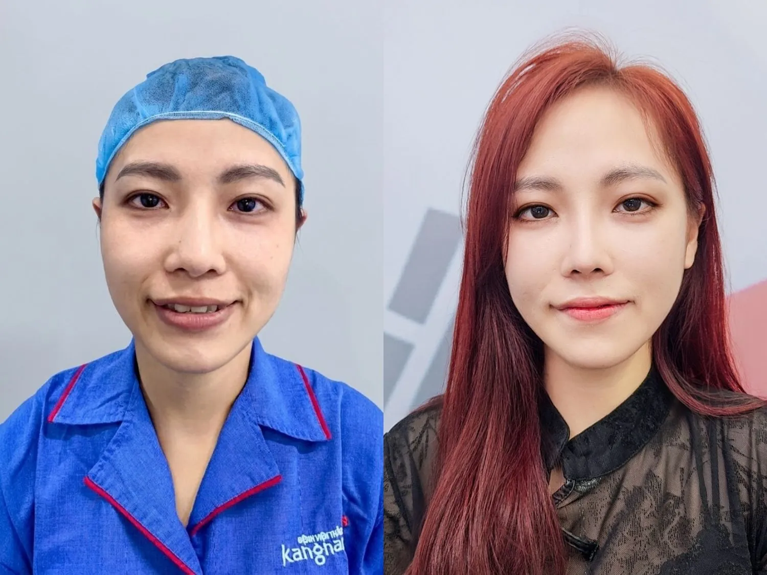 ảnh trước và sau khi hạ gò má của khách hàng