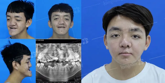 Điều chỉnh hàm ếch an toàn và hiệu quả