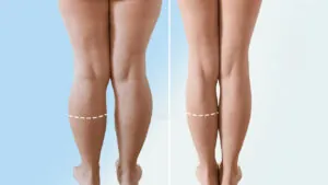 Hút mỡ bắp chân: Giảm size bắp chân, sở hữu dáng thon gọn