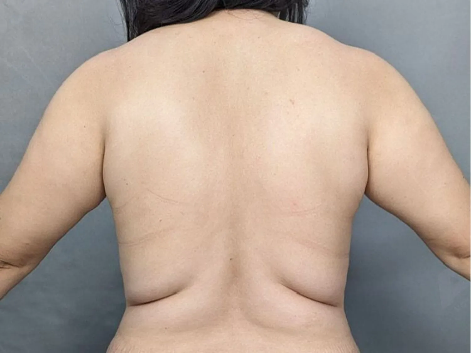 Mỡ vai rất khó giảm