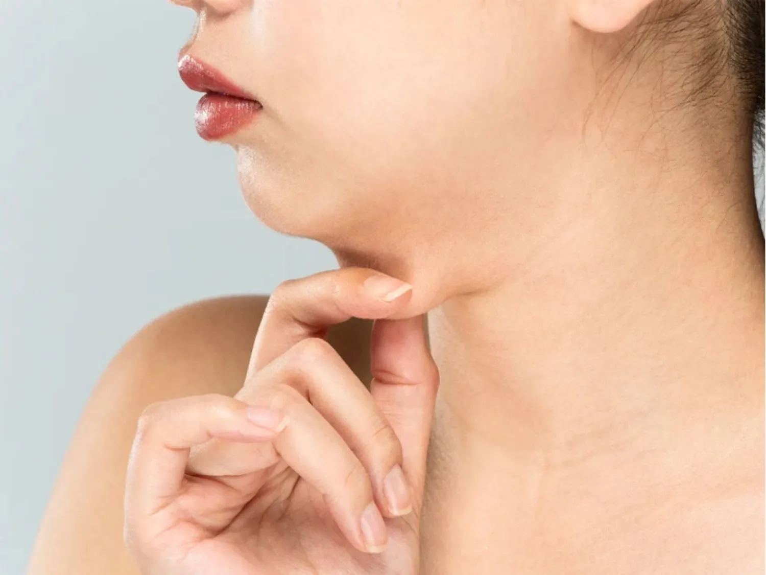 tình trạng nọng cằm do mỡ tích tụ lâu năm, có thể véo lên được
