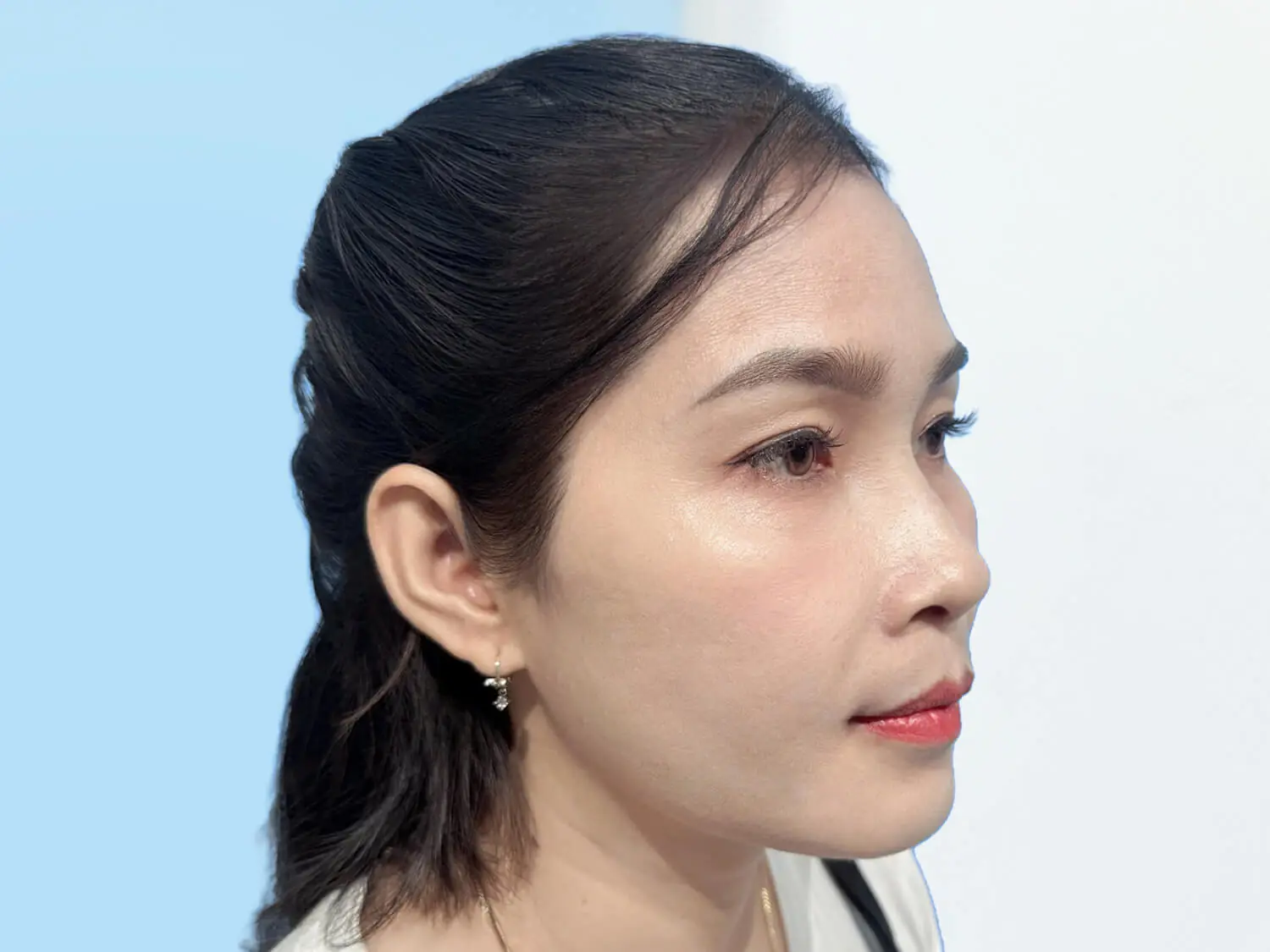 Chị Loan sau khi chỉnh hàm, gương mặt cân đối và hài hòa hơn