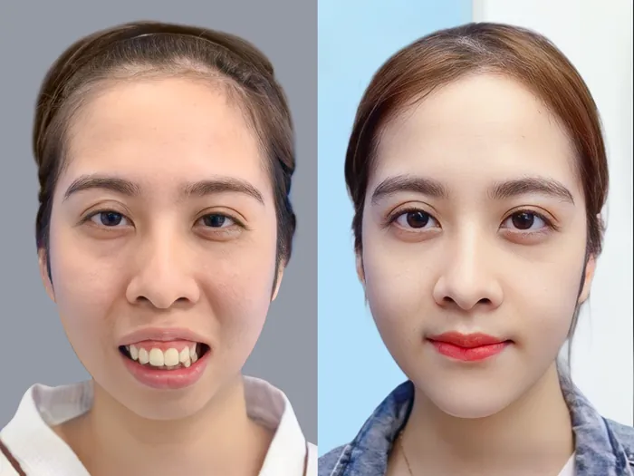 Hình ảnh cấu trúc xương hàm trước và sau khi thực hiện phẫu thuật điều chỉnh khớp cắn tại Kangnam.