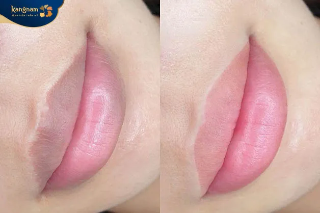 Cần phụ thuộc vào mức độ thâm môi của mỗi người