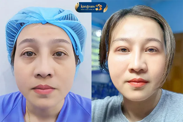 Cắt mí dưới cải thiện vẻ bề ngoài